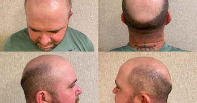 Transplante capilar com 30 mil fios bate recorde em procedimento realizado por Gustavo Amarante